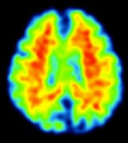 Amyloid PET axial view 1 showing increased cortical uptake