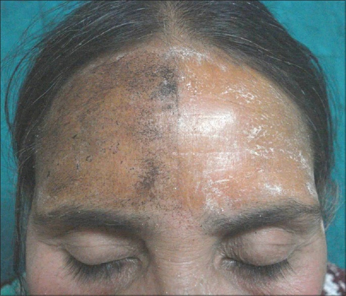Iodine-starch test 결과 사진. 얼굴의 한쪽(우측)은 검게 변하여 정상적인 발한을 보이나, 반대쪽(좌측)은 변색되지 않아 무한증이 있음을 보여줌.