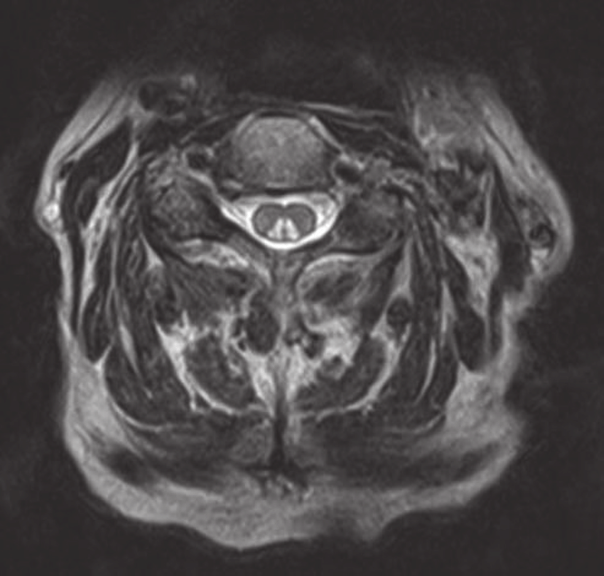 MRI C-spine axial T2WI: Posterior column에 대칭적인 고신호강도가 관찰됨(Inverted V-sign)