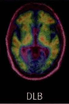 Amyloid PET: 음성 소견(비특이적)