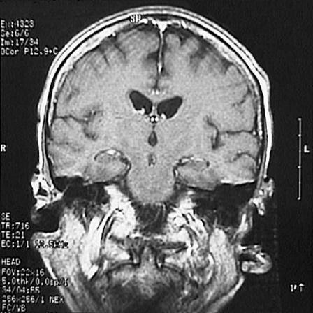 T1-weighted Coronal MRI: 내측 측두엽 위축이 저명하지 않음
