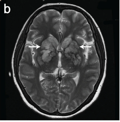 뇌 MRI(B): T2 강조 영상에서 기저핵 부위에 다발성으로 관찰되는 고신호강도의 가성낭종 소견