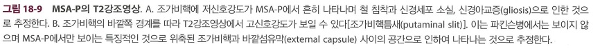 MRI 소견에 대한 상세 설명 텍스트 이미지.