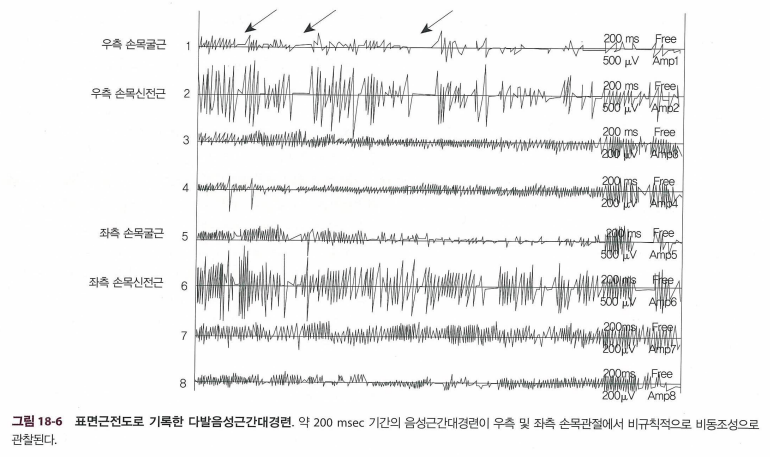 표면근전도