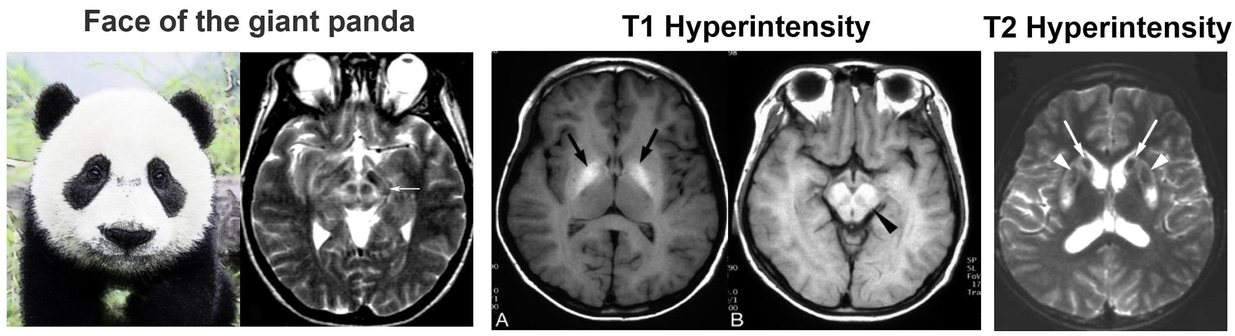 Wilson's Disease MRI Findings