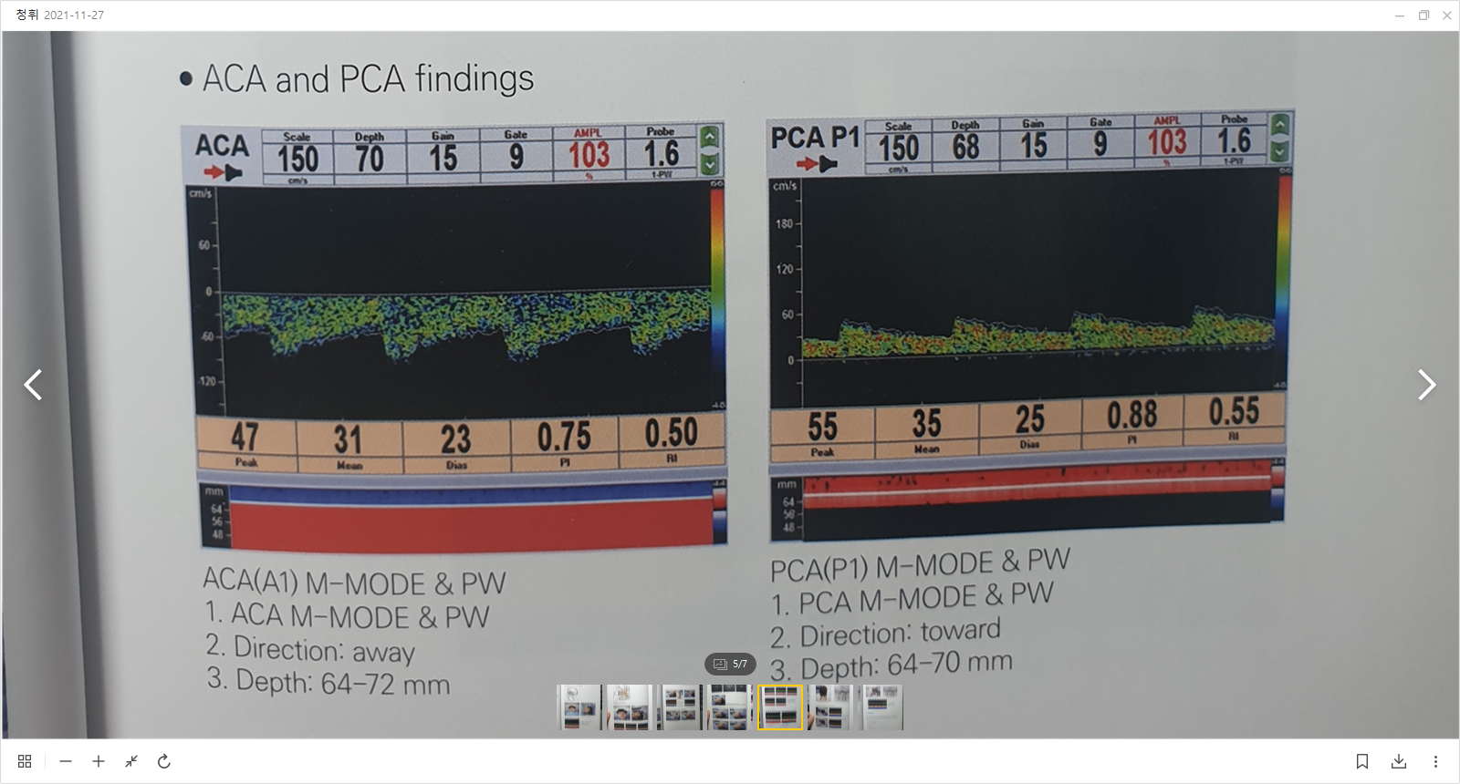 ACA 및 PCA 파형 비교