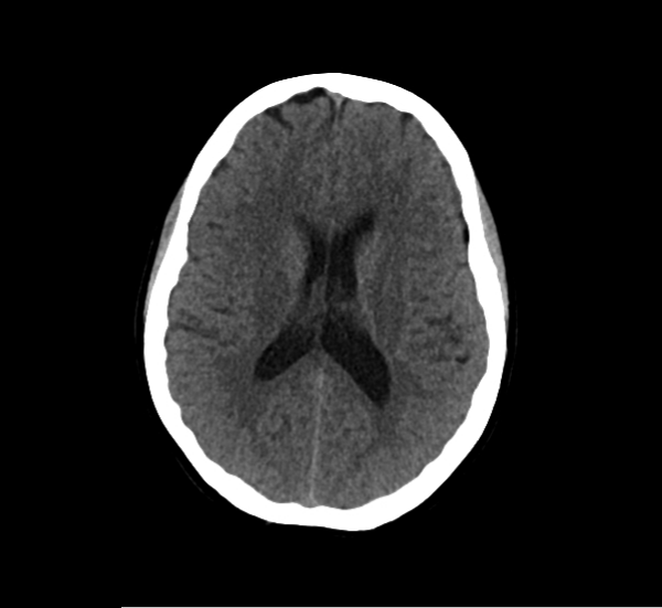 뇌 비조영 CT 사진. 좌측 기저핵(basal ganglia) 부위의 음영 저하가 의심되나 명확한 고음영의 뇌출혈 소견은 보이지 않음.