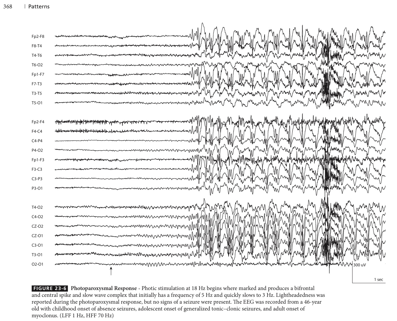 Atlas of EEG Patterns - Photoparoxysmal Response