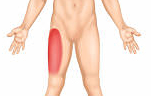 인체 전면도에서 우측 허벅지 외측부(Lateral femoral cutaneous nerve 영역)가 붉게 표시된 삽화