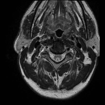 경추 MRI T2 강조 축상면 영상에서 척수 후주(posterior column) 부위에 대칭적인 고신호강도가 관찰되어 'Inverted V sign'을 보임.
