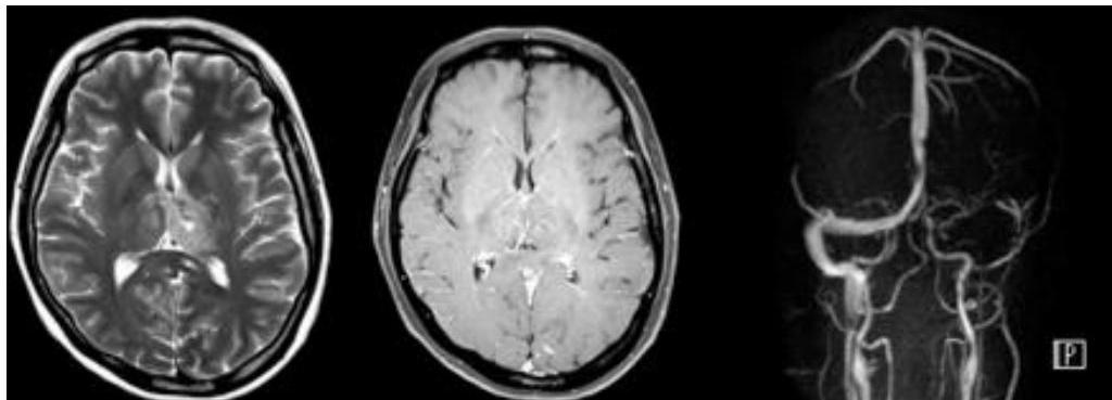 뇌 MRI 및 MRV 소견