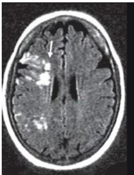 Brain MRI FLAIR axial view