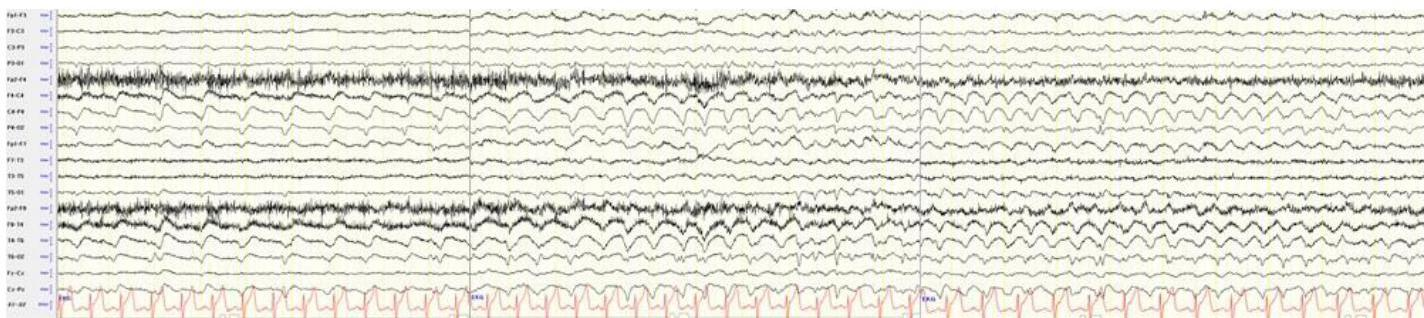 뇌파 검사(EEG)