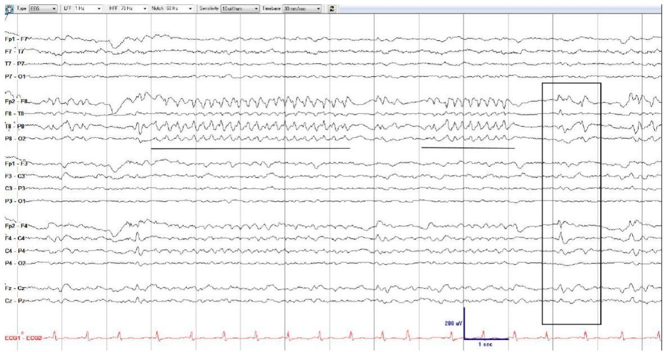 EEG showing BIRDs