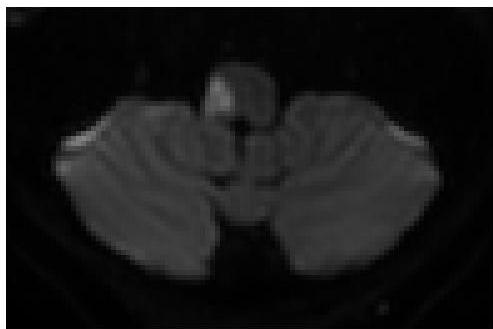 MRI-DWI-1