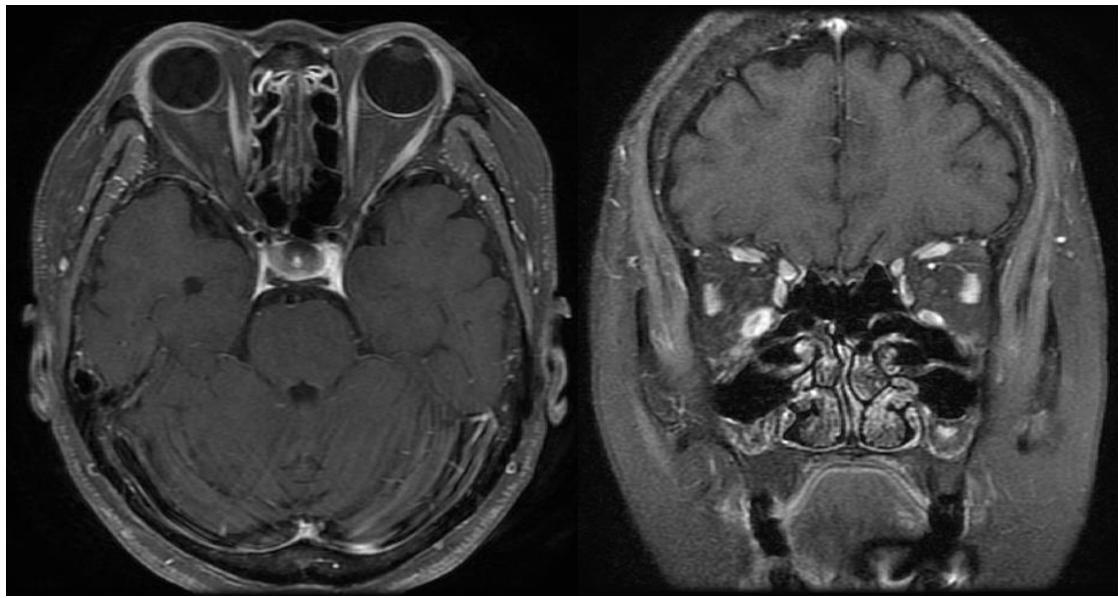 Orbit MRI