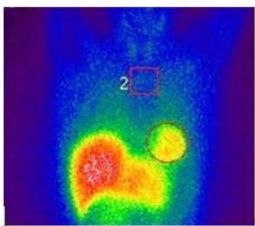 MIBG Scintigraphy