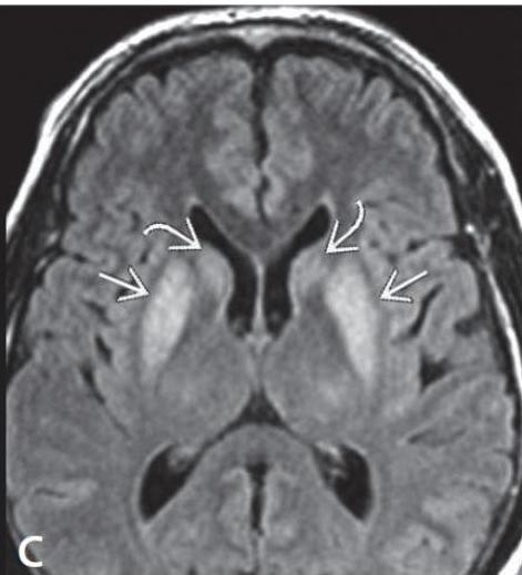 MRI FLAIR image