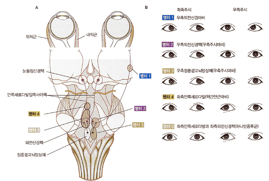 뇌간의 안구 운동 경로 모식도: PPRF에서 외전신경핵을 거쳐 반대측 MLF를 통해 눈돌림신경핵으로 이어지는 경로