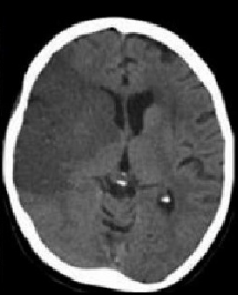 Brain CT