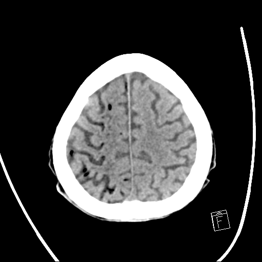 뇌 CT 영상에서 우측 대뇌 반구의 혈관을 따라 다발성의 검은 공기 음영(Air embolism)이 관찰됨.