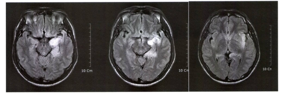 Brain MRI