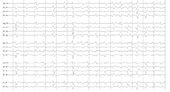 EEG showing typical triphasic waves with frontocentral dominance and symmetric distribution.