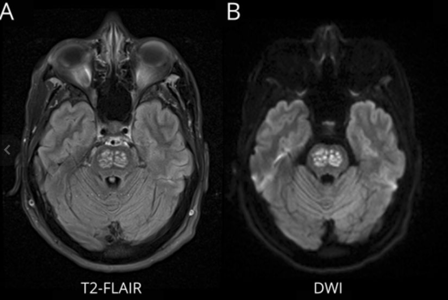 MRI T2/FLAIR 영상: 다리뇌(pons) 중앙부에 대칭적인 고신호강도 병변이 관찰됨.