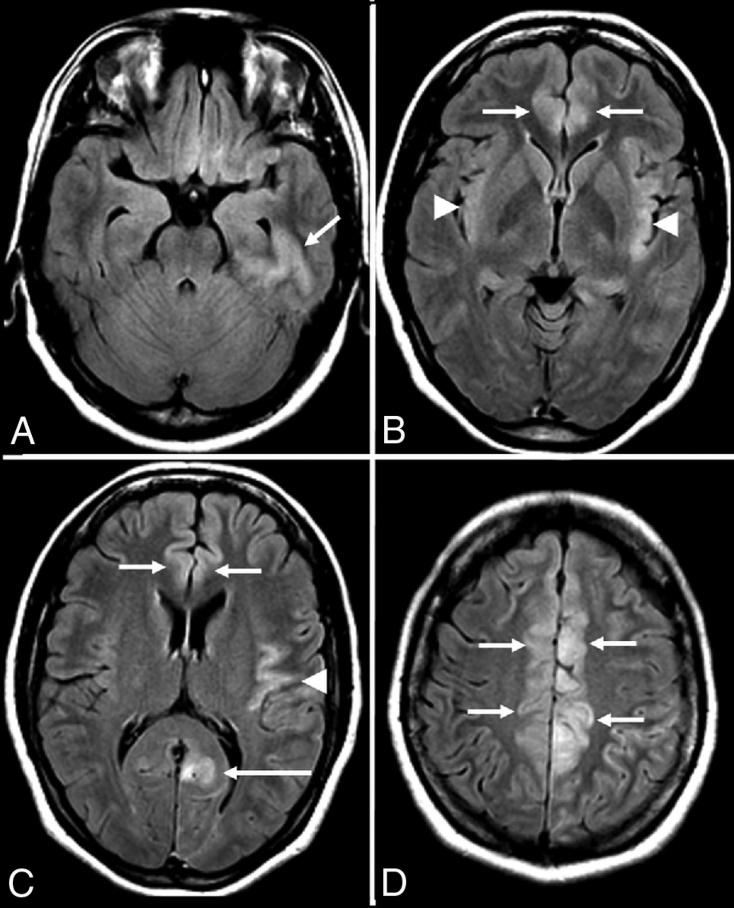 뇌 MRI FLAIR 영상에서 양측 내측 측두엽과 섬엽 부위에 고신호강도가 관찰됨.