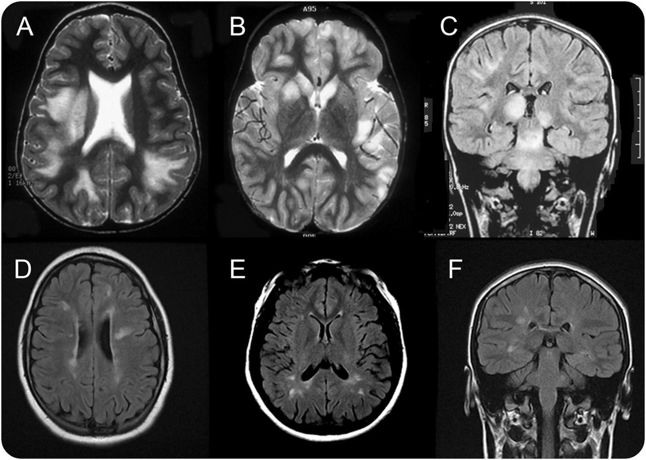 Brain MRI (FLAIR/T2)
