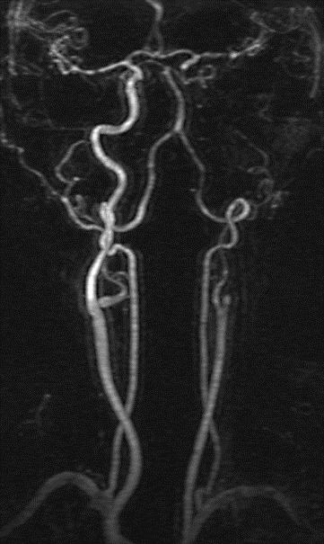 Contrast-enhanced MRA