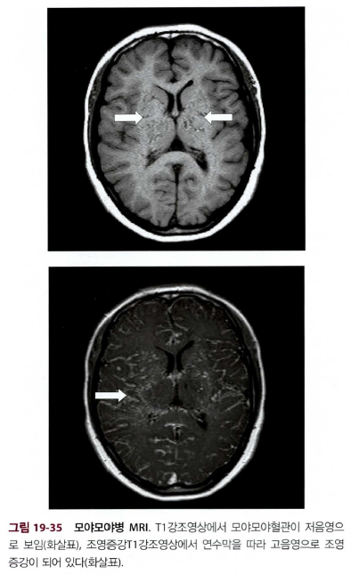 모야모야병의 단계별 혈관조영술 소견 및 MRI 특징 요약