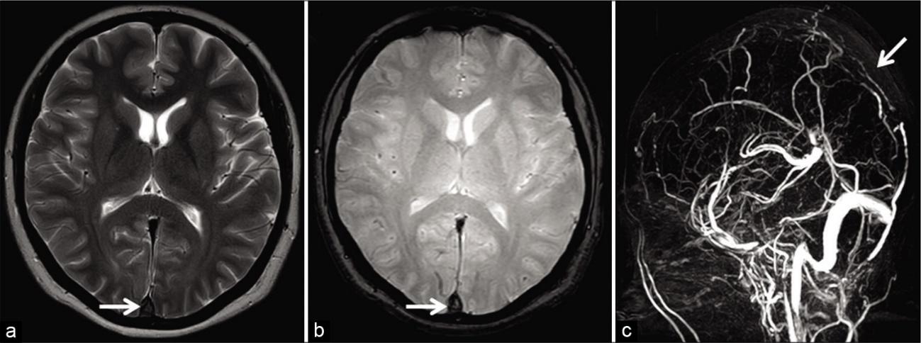 MRI FLAIR: 정맥동 내 고신호강도의 혈전 및 인접 뇌실질의 부종 관찰