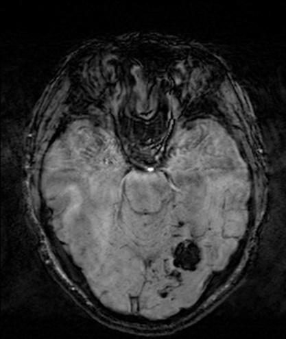 MRI SWI: 정맥 울혈에 의한 미세 출혈 또는 혈전 내의 저신호강도 확인