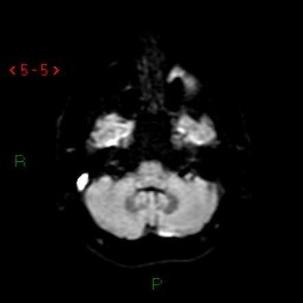 MRI DWI: 정맥성 경색에 의한 확산 제한 병변 관찰