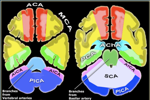 소뇌 혈관 지배 영역 모식도: PICA, AICA, SCA 영역 구분.