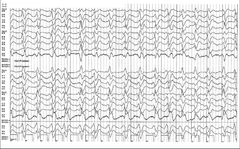 EEG