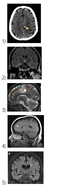 뇌 시상면 MRI T1 강조 영상에 1번부터 5번까지 번호가 매겨진 이미지. 1번은 전두엽 전방, 2번은 전두엽 상부, 3번은 중심전회(precentral gyrus) 부근의 내측면, 4번은 두정엽 후방, 5번은 후두엽을 가리키고 있음.
