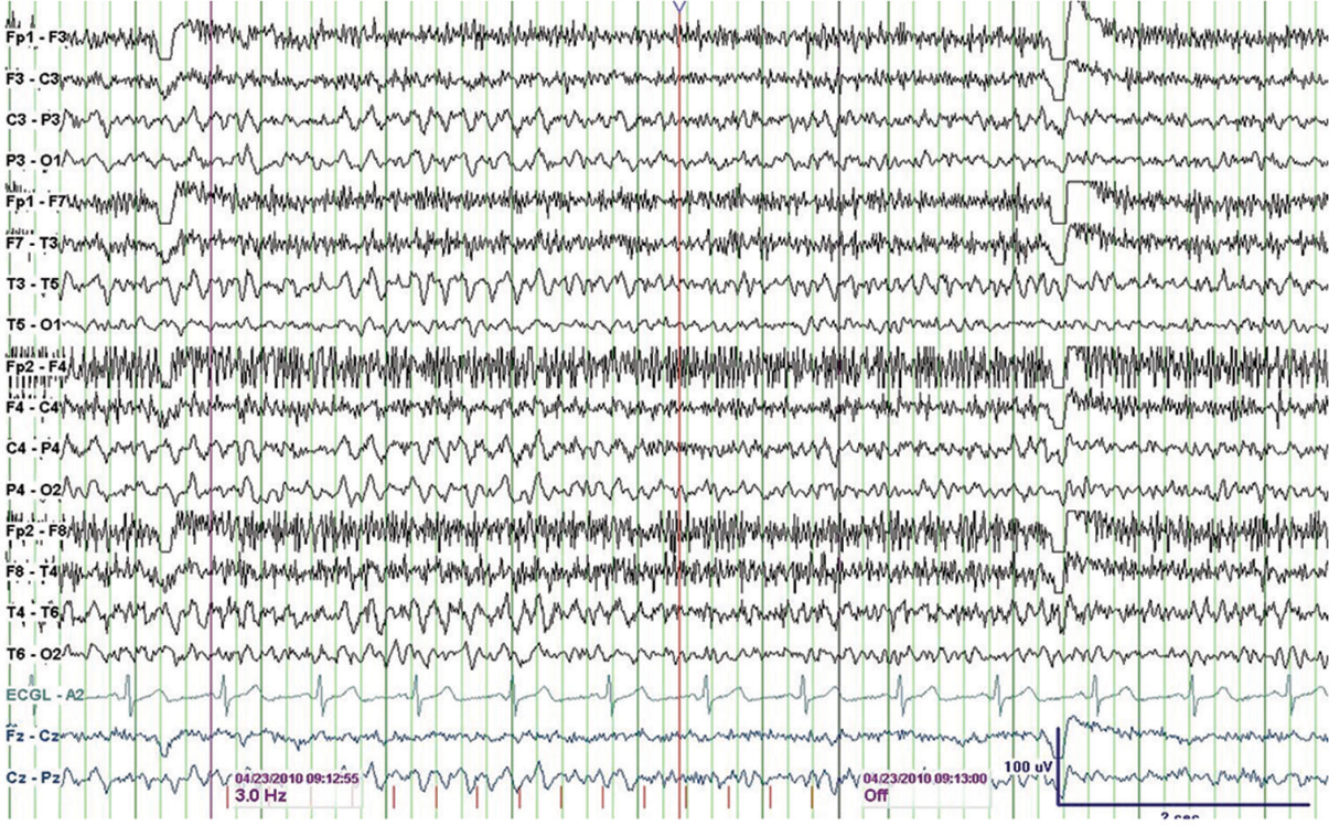 Normal EEG with Photic Driving