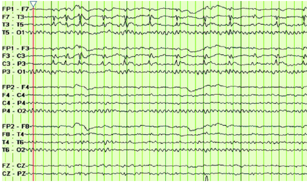 EEG of Benign Rolandic Epilepsy showing centrotemporal spikes