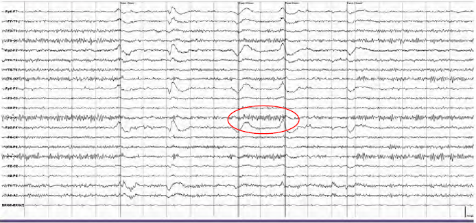 Posterior fast alpha variants 예시