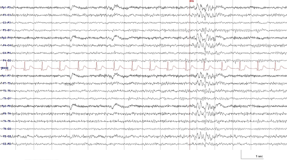6Hz spike-wave complexes 예시