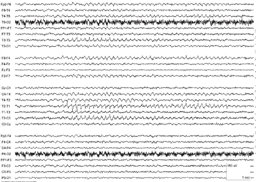 RMTD (Psychomotor variant) 예시