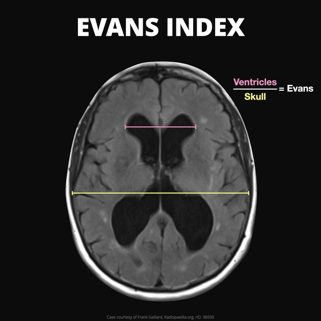 Evans index 측정법 모식도. Frontal horn width(B)와 Inner table of skull width(D)를 화살표로 표시하여 B/D 관계를 설명함.