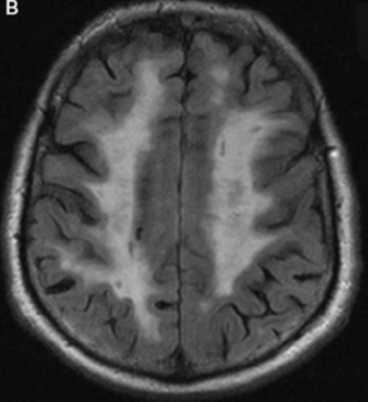 Brain MRI FLAIR/T2: Diffuse white matter hyperintensities involving the anterior temporal lobes.