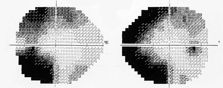 시야 결손 양상