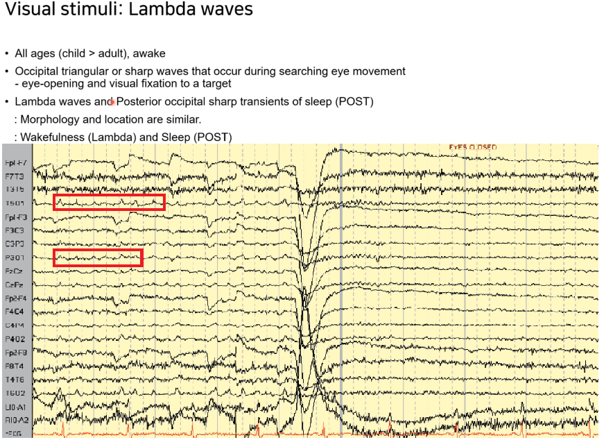 각성 상태에서 나타나는 Lambda wave와 눈을 감았을 때 나타나는 Alpha rhythm 비교 뇌파