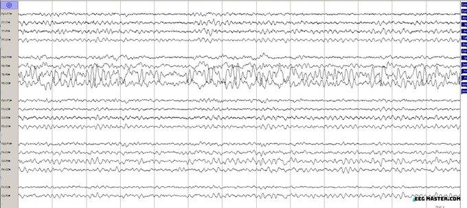 EEG showing breach rhythm