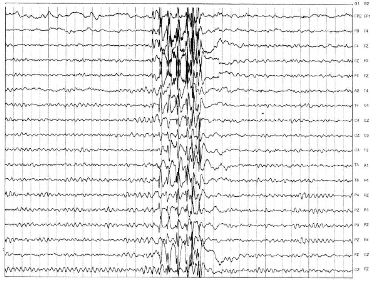 EEG showing generalized 4-6Hz polyspike-and-wave complexes