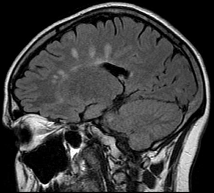 MRI-FLAIR 1